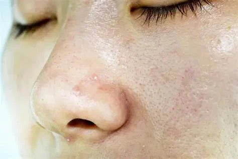 Fettige Haut? Eine Skincare routine Empfehlung - Seoulma-skincare